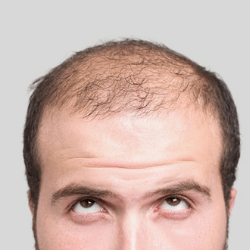 Trichology - Hair loss solutions and treatment of other hair disorders