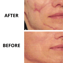 Laser & RF treatments for scars (post-acne, post-surgery etc.)