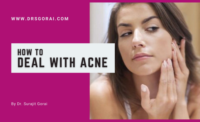 How to Deal with Acne