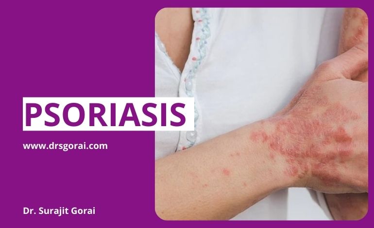 Psoriasis - Not Just Skin Disease
