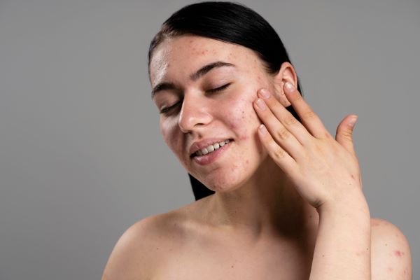 Unlatch Clear Skin Chemical Peel for Acne Scar Treatment